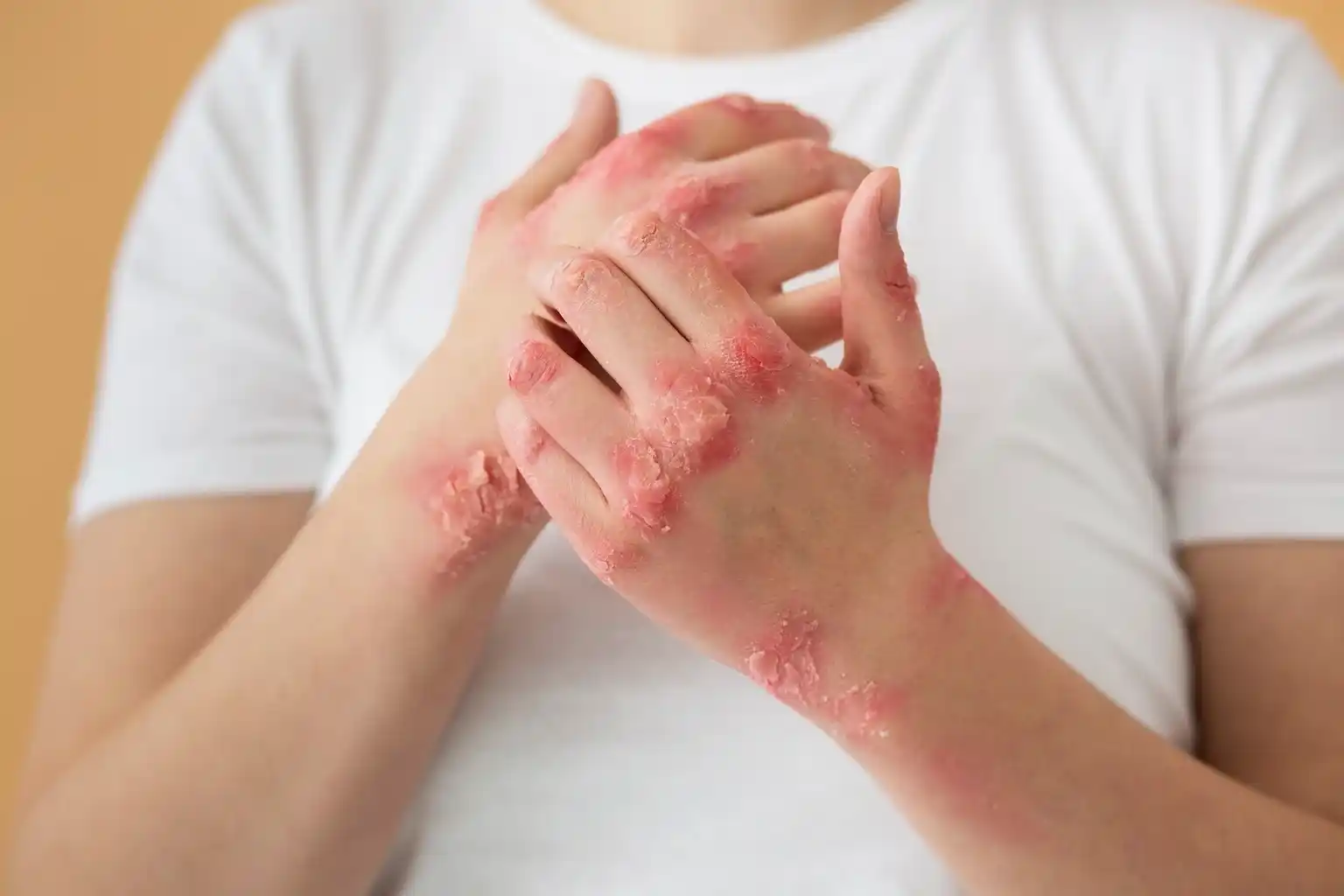 Psoriasis: Uncovering the Roots and Finding Lasting Relief with Functional Medicine