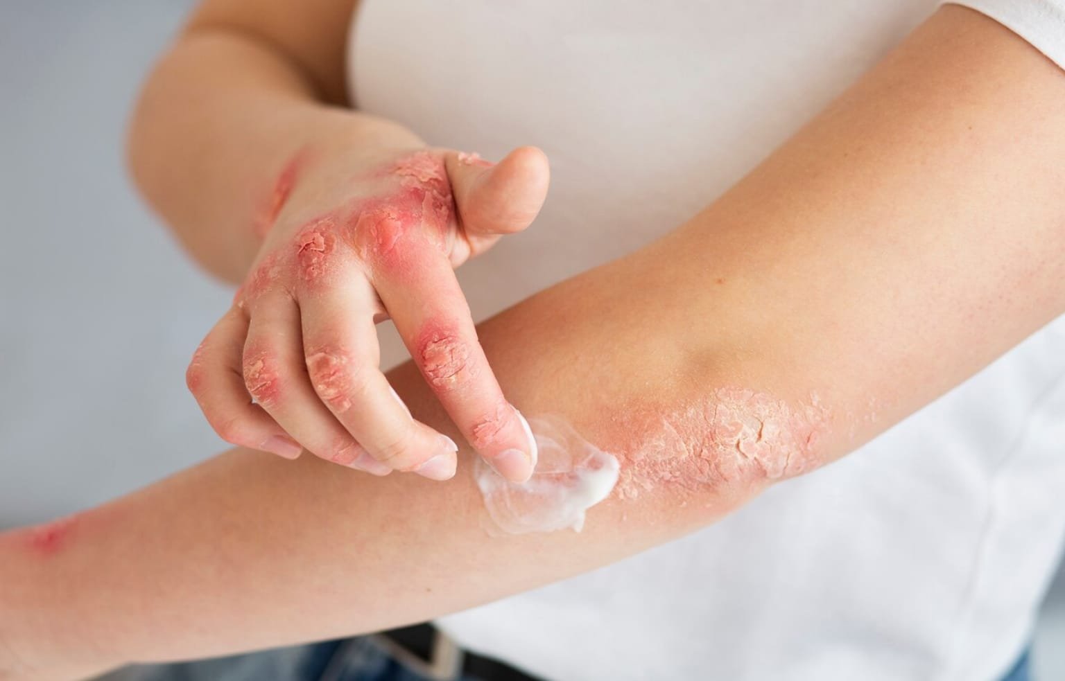 Psoriasis: Uncovering the Roots and Finding Lasting Relief with Functional Medicine