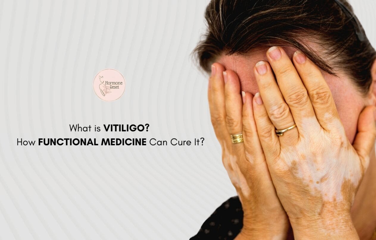 What is Vitiligo? How Functional Medicine Can Cure it?
