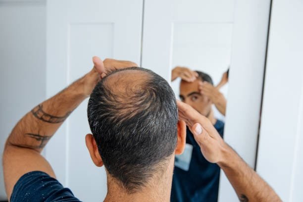 Breaking Down Alopecia: A Functional Medicine Viewpoint on Hair Loss 2 Alopecia