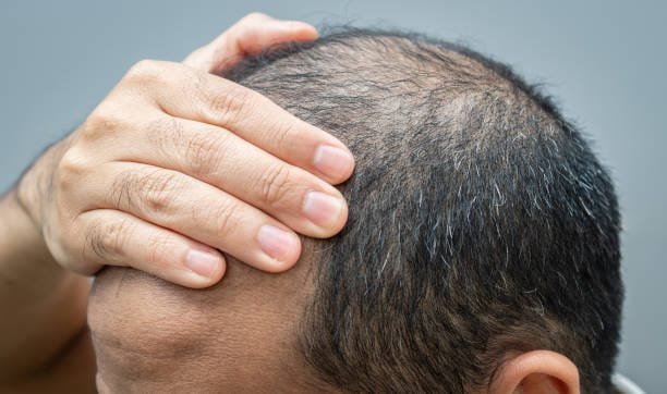 Breaking Down Alopecia: A Functional Medicine Viewpoint on Hair Loss 5 Alopecia